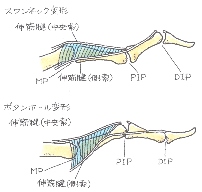 手指の変形